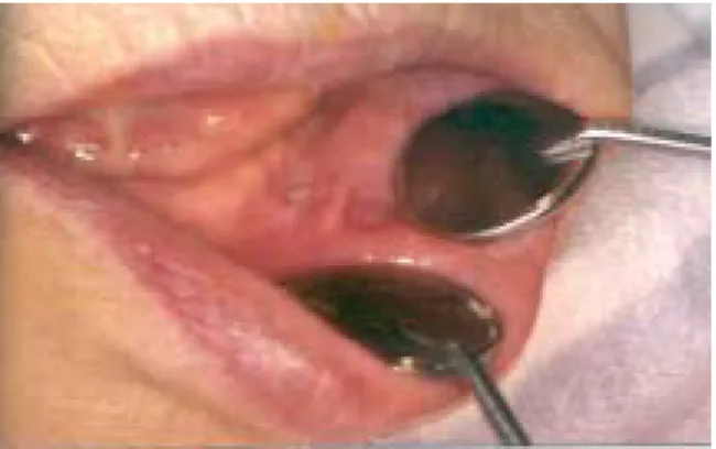 Fig.  11.  After  1  week,  another  new  hyperplastic  tissue  on  operation  site,  so  denture  was  relieved  again.