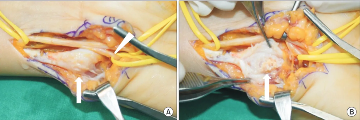 Fig. 3.	Operative	findings.	(A)	Flexor	carpi	ulnaris	tendon	hypertrophy	and	calcification	(arrow)	over	the	pisiform	and	ulnar	nerve	motor	branch	 (arrowhead)	compressed	by	thickened	flexor	carpi	ulnaris	tendon	were	observed.	(B)	Abundant	calcific	materials