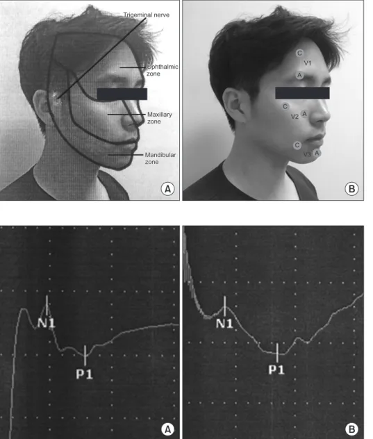 Fig.  2.	 Trigeminal	 somatosensory	 evoked	potential	following	stimulation	 of	(A)	V1	branch	and	(B)	V2	branch,	 respectively.	Sweep	speed	5	ms/D,	 Sensitivity	20	mV/D.