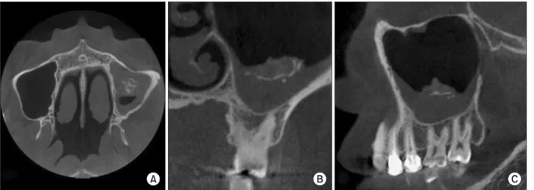 Fig. 2. Cone beam computed tomography view shows moderate mucosal thickening including small calcified bodies of the left maxillary sinus