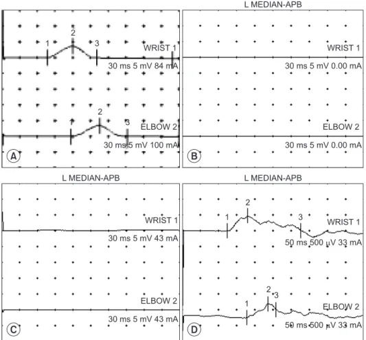Fig. 1.  Serial compound motor action  potentials (CMAPs) on left abductor  pollicis brevis muscle