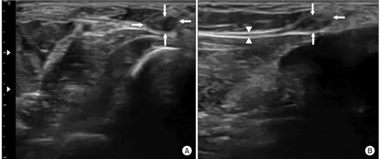 Fig. 2. Transverse (A) and longitudinal (B) sonograms at the site of positive Tinel sign demonstrated a round hypoechoic mass (arrows, 2.8 x 5.3  x 6.5 mm) at end of the right dorsal ulnar cutaneous nerve (arrow heads).