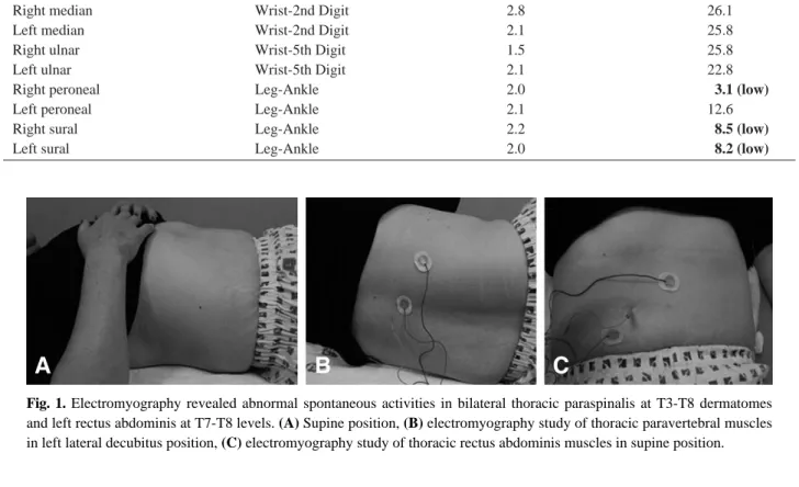 Fig. 1. Electromyography revealed abnormal spontaneous activities in bilateral thoracic paraspinalis at T3-T8 dermatomes and left rectus abdominis at T7-T8 levels