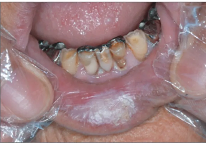 Fig. 1. Whitish hyperkeratotic lesion on the lower lip at the first  visit.