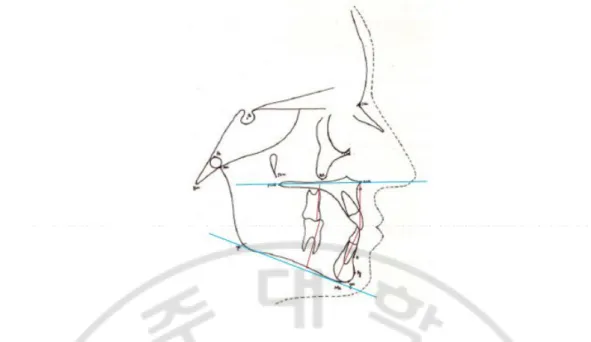 Fig. 2. Linear dentoalveolar parameters used in the study. LPDH (mm), UPDH (mm), 