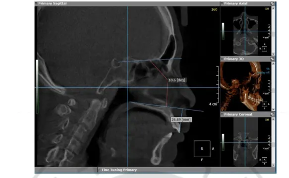Fig. 3. Angular and linear measurements on CBCT image using Ondemand 3D  software (Cybermed, Seoul, South Korea)
