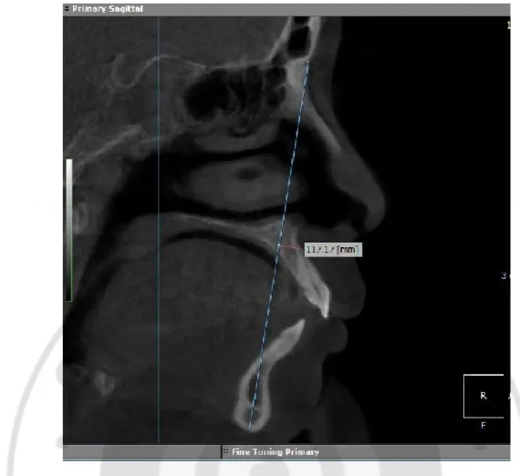 Fig. 5. Linear measurement on magnified CBCT image. Measurement image of AFH 