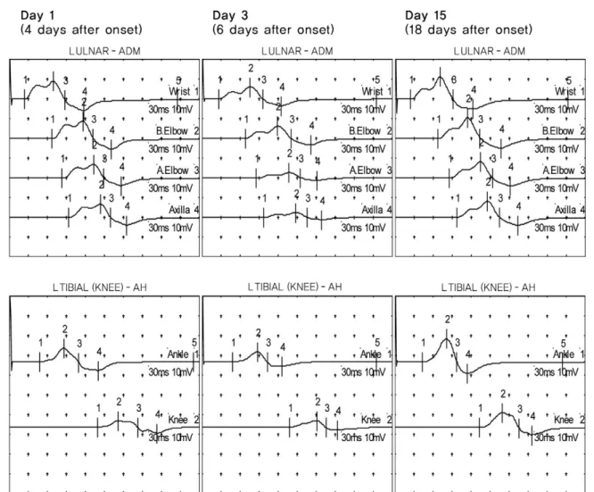 Fig. 1. Serial recordings of motor nerve conduction study. Upper tracings: left ulnar nerve motor conductions recorded from abductor digiti minimi muscle