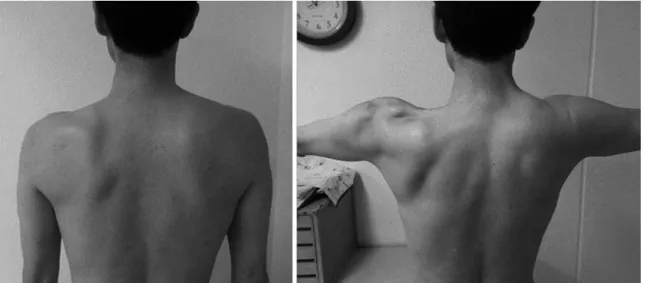 Fig. 1. Winging scapula and trapezius muscle atrophy in the left shoulder.
