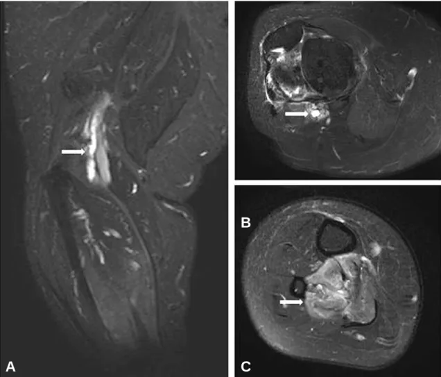 Fig. 1. MRI (T2 weighted image) of the right lower extremity. (A) Perineural elongated shaped cystic lesion (arrow) along the course of the distal sciatic and proximal tibial nerves is demonstrated
