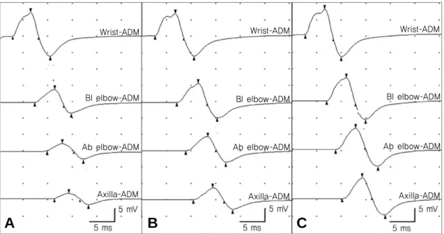 Fig. 1. Motor Nerve Conduction Studies of Left Ulnar Nerve. (A) Conduction block across wrist and elbow were found at 5 days after disease onset