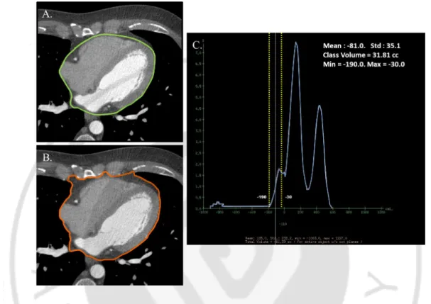 Fig.  1.  Quantification  of  epicardial  (EAT)  and  thoracic  adipose  tissue  (TAT)  using  dedicated  software using contrast enhanced MDCT