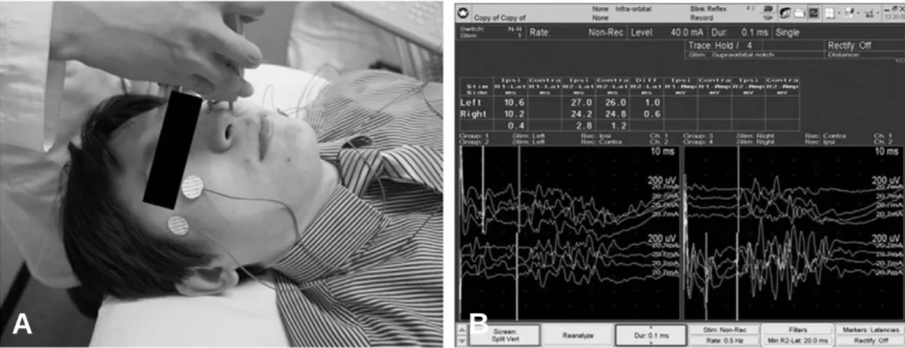 Table 3. Results of Blink Reflex of Control and Patients 