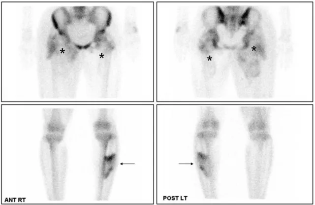 Fig. 1. Tc-99m MDP bone scans show increased tracer uptake localized to muscle groups of both buttock, thigh (asterisk), left lower leg (arrow)