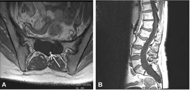 Fig. 1. MRI images showing a fatty filum terminale (arrow) bright on T1 image (A), and low-lying conus medullaris (B)
