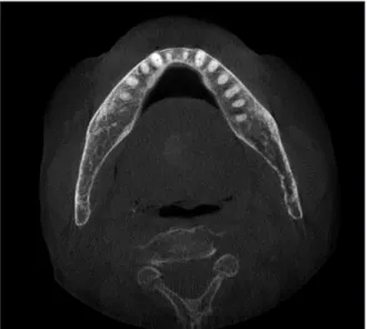 Fig. 5. A 2 year follow-up computed tomography view. Healing  state at anterior mandible area.