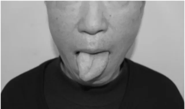 Fig. 2. The tongue atrophy and deviation of the patient of second case.