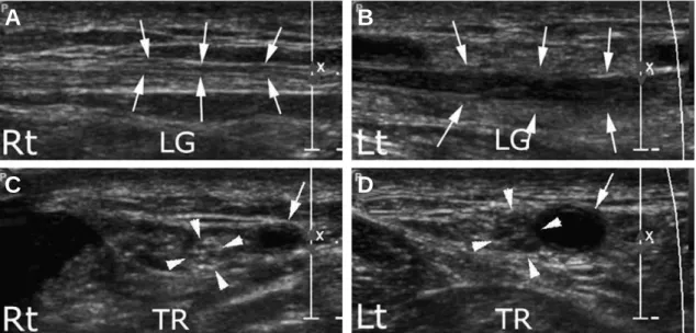 Fig. 4. Longitudinal and transverse ultrasound scan of left calf compared with right side