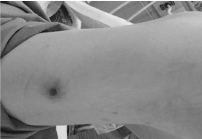 Fig. 1. Eschar of the case 2. A small black colored eschar is shown on right posterior thigh.