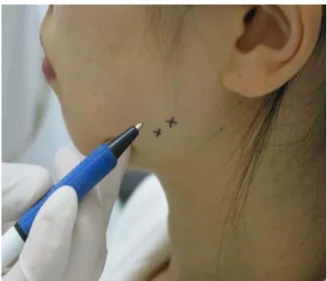Fig.  3.  Injecting  BTXA Ⓡ