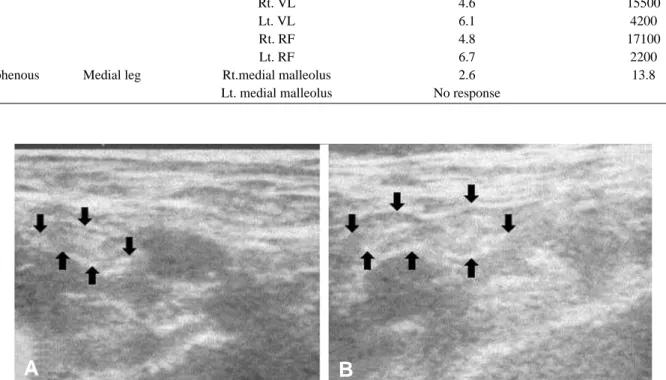 Fig. 2. Ultrasonography findings of femoral nerve below inguinal ligament. Left femoral nerve (B) was larger than right femoral nerve (A)