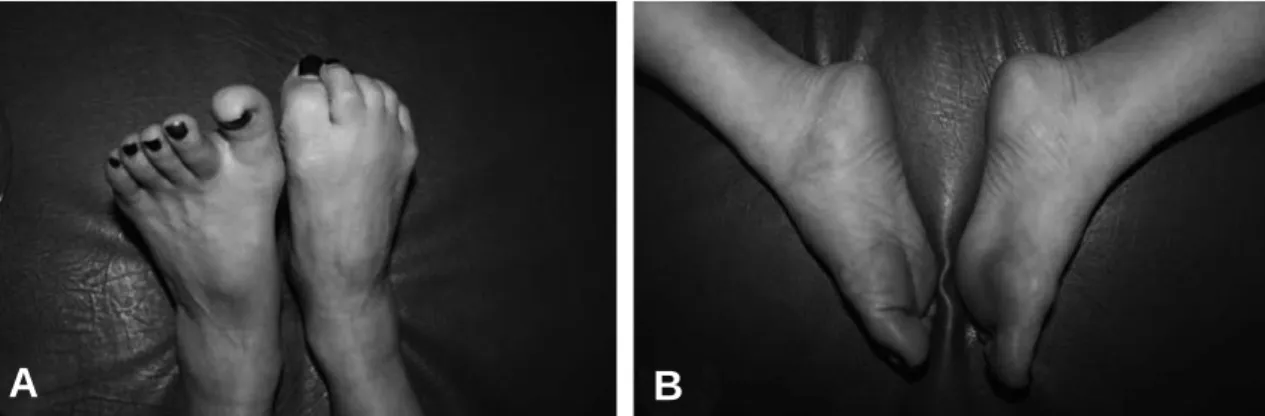 Fig. 1. The comparisons of both toe flexion shows motor weakness of left toe flexor muscles (A)