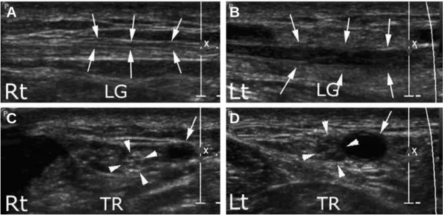 Fig. 4. Longitudinal and transverse ultrasound scan of left calf compared with right side