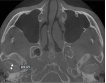 Fig. 3. Oblique sagittal image shows measurement of condyle  height.