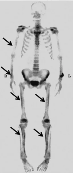 Fig. 3. Bone scan shows diffusely increased cortical uptake in the both upper and lower extremities (black arrows).