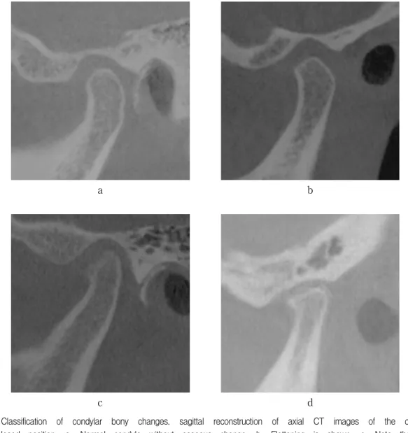 Fig.  1.  Classification  of  condylar  bony  changes.  sagittal  reconstruction  of  axial  CT  images  of  the  condyle  in  closed  position