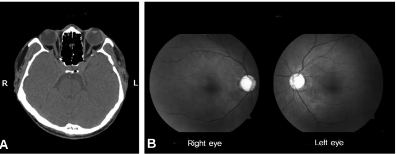 Fig 1. (A) Orbit and facial computed tomography at 2 months after closed head-injury shows bilateral optic nerve atrophies (arrows) without any evidence of direct trauma to optic nerve by orbital rim fracture