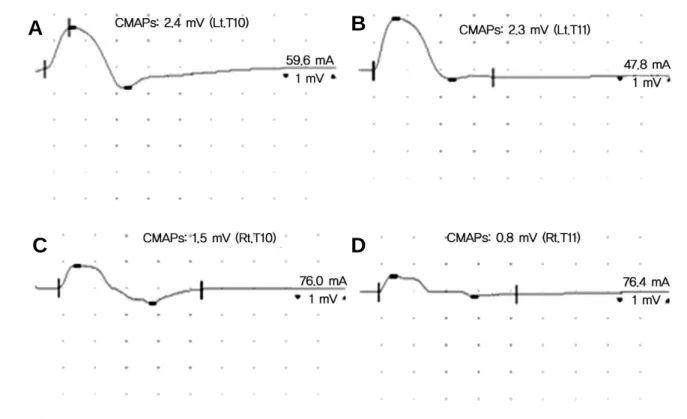 Fig. 3. Compound muscle action potential of intercostal nerve. Nerve conduction study showed low CMAPs on right intercostal nerves compared with left side
