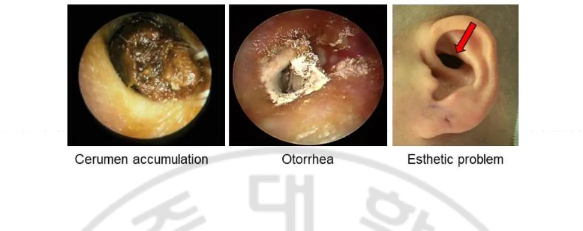 Fig. 1. Various complications after mastoidectomy such as accumulation of cerumen  and keratin debris, otorrhea, or esthetic problems 