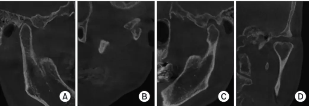 Fig. 2. Cone-beam computer tomography image taken on two-week-follow-up check. (A) Right condyle does not show any gross  abnormalities