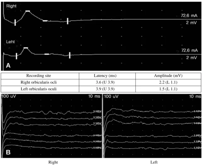 Fig. 1. The facial motor nerve conduction test shows no abnormality (A) and there is no response of R1 and R2 on both sides in the blink reflex test (B)