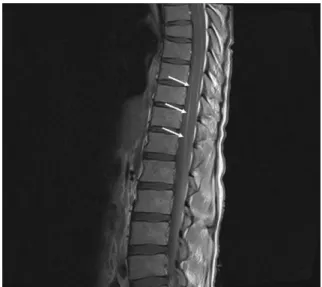 Fig. 2. Thoracic-lumbar junction enhanced MRI shows diffuse leptomeningeal enhancement on thoracic and  lum-bar spinal cord and cauda equine (arrows).