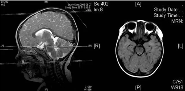 Fig. 1. MRI brain T2-weighted image demonstrate no gross abnormality in midbrain and pons.