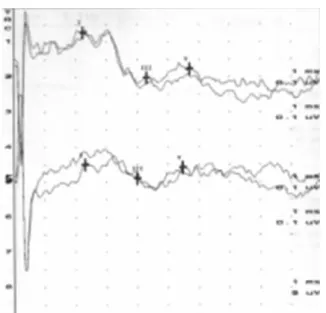 Fig. 2. Initial BAEP study shows normal response. No def- def-inite evidence of auditory pathway lesion.