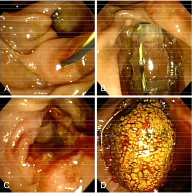 Fig. 1. Endoscopic view of large-balloon dilation without biliary sphincterotomy. A. Guidewire 