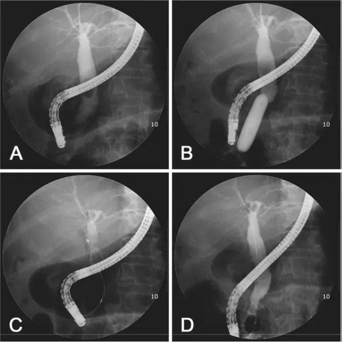 Fig. 2. Fluoroscopic view of large-balloon dilatation without biliary sphincterotomy. A