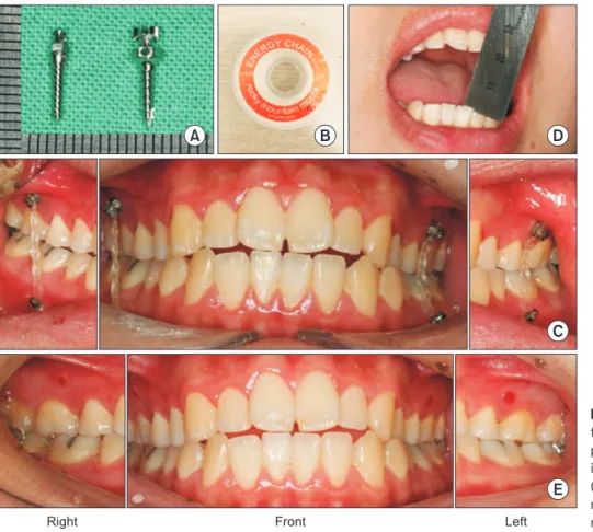Fig. 5. Microimplant-assisted intemaxillary  fixation. (A) Microimplants. (B) Elastic  power chain