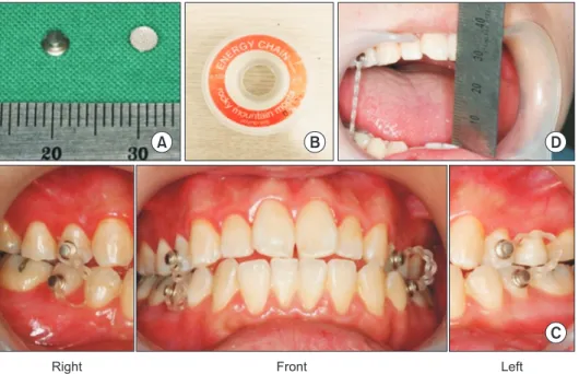 Fig. 6. Button-assisted intemaxillary fixa- fixa-tion. (A) Button. (B) Elastic power chain