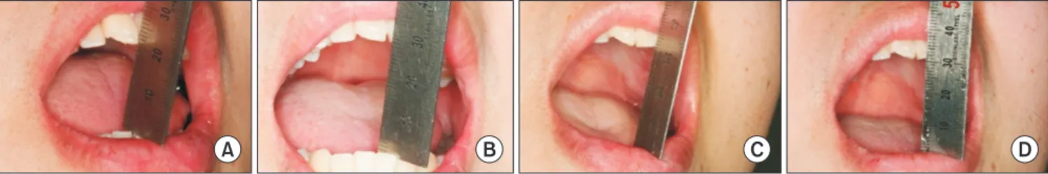 Fig. 7. Change of comfortable mouth opening range after microimplant-assisted intermaxillary fixation