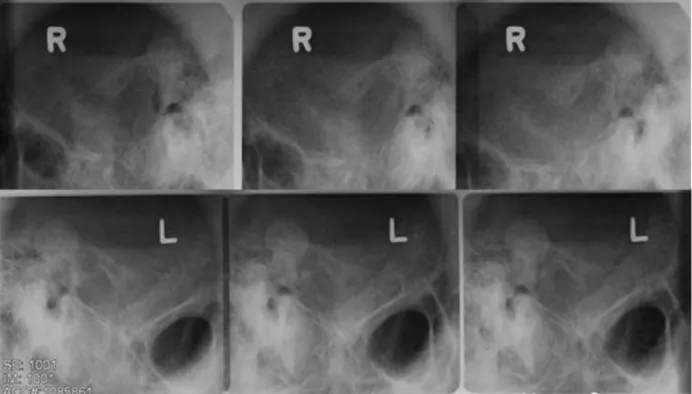Fig. 3. Transcranial view at the first visit illustrates reduced bony density and poorly outlined mandibular cortex.