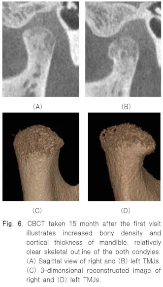 Fig. 5. Panoramic view taken after 15 months later reveals increased bony density and cortical thickness of the mandible.