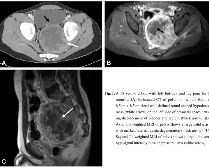 Fig. 1. A 13 year-old boy with left buttock and leg pain for 5 months. (A) Enhanced CT of pelvis shows an 10cm x 8.5cm x 8.5cm sized well-defined round shaped hypodense mass (white arrow) on the left side of presacral space  caus-ing displacement of bladde