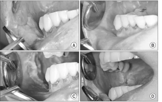 Fig. 1. Medical intervention that hugely  changes the lesion. (A) After 1-month  follow up (after 1 month from the  begin-ning of the treatment with topical  cor-ticosteroid agents)
