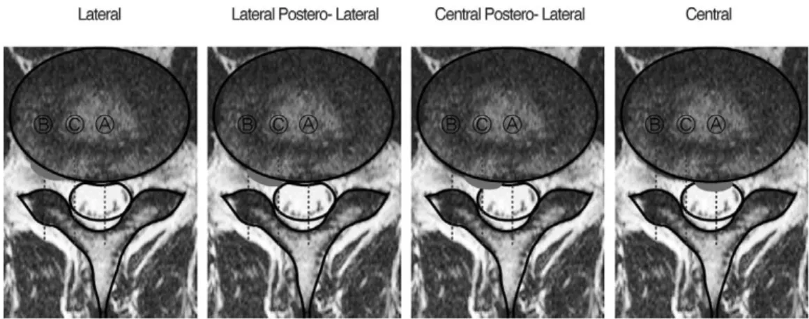 Fig. 1. Classification of Disc Herniated Direction