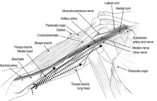 Fig. 1. Diagram shows the brachial plexus and adjacent structures. The semicircle indicates the entry site for suction and dotted lines demonstrate the directions of liposuction cannula.