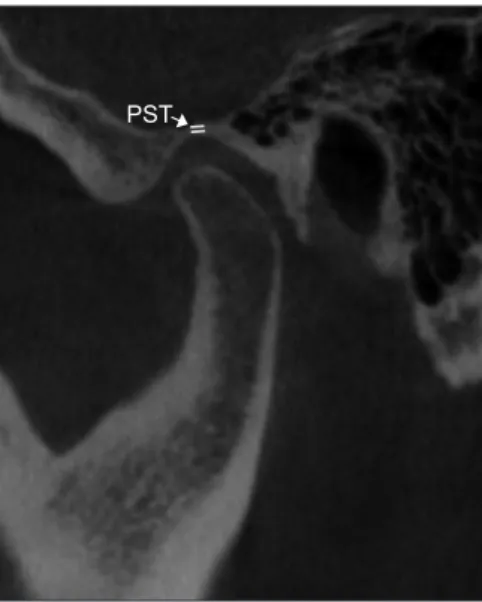 Fig. 2. Parasagittal reconstructions of cone beam computed to- to-mography images. PST, parasagittal thickness of the roof of the  glenoid fossa.